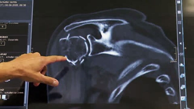 Röntgenbild: Osteoporose im Schultergelenk