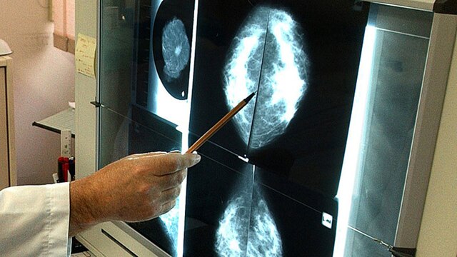 Auswertung von Mammografieaufnahmen