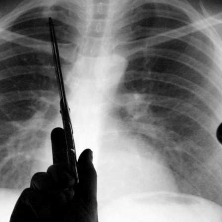 Ein Arzt ist im Anschnitt vor der Röntgenaufnahme einer Lunge zu sehen, mit einer Schere zeigt er auf kranke Stellen des Organs