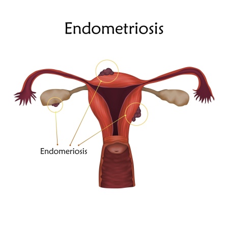 Grafische Darstellung einer Endometriose