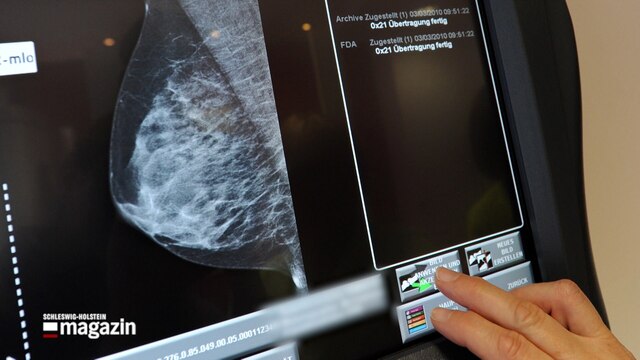 Eine Röntgenaufnahme einer weiblichen Brust auf einem Bildschirm.