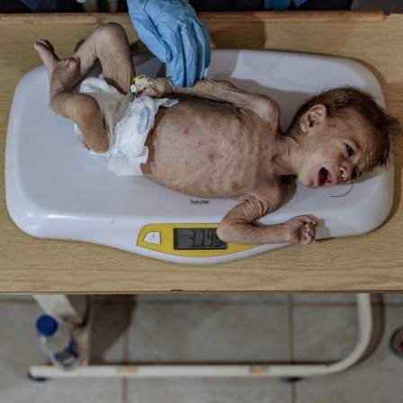 Medizinisches Personal untersucht ein Kind in einer Klinik für Unterernährung im HIHFAD-Krankenhaus in der Stadt Atimah. Die Bewohner der Lager im Nordwesten Syriens leiden unter den schwierigen humanitären Bedingungen, die durch die Finanzierungslücke entstanden sind.