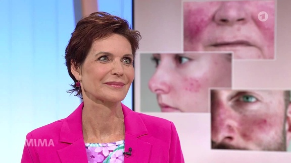 Mittagsmagazin - Mima-service: Rosazea – Wenn Das Gesicht Glüht