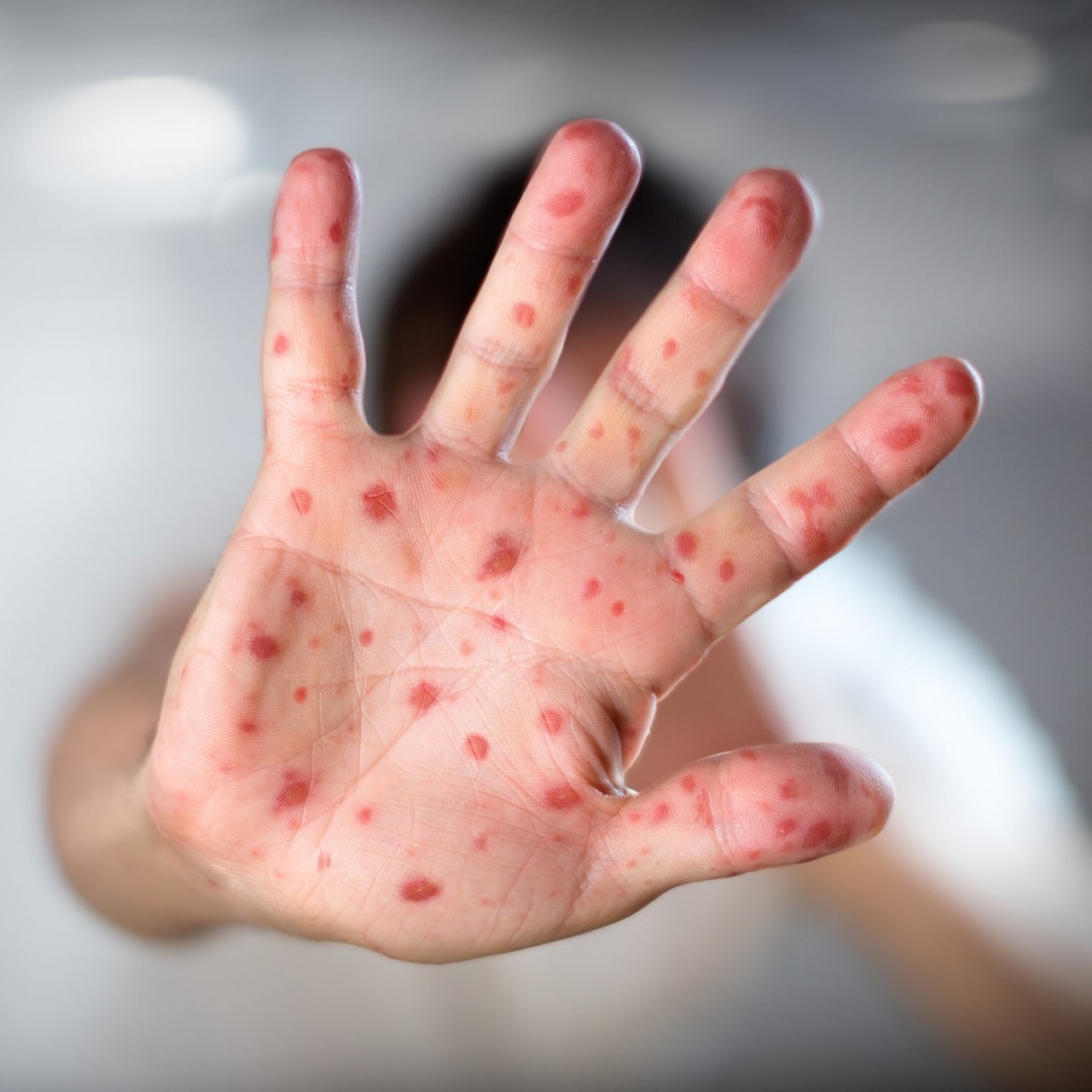 Das Interview · Ärzte Bislang kein Anstieg von Masern in Deutschland