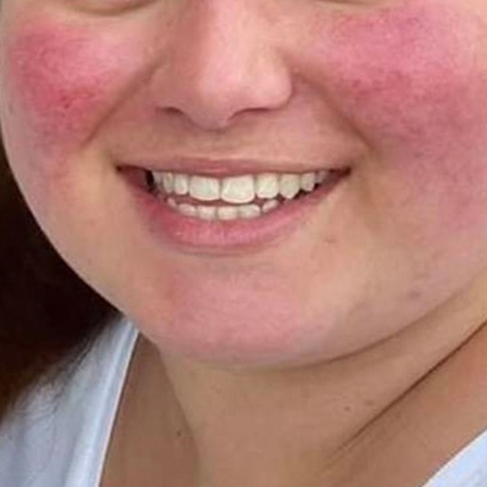 Junge Frau mit dem "Cushion Syndrom"
