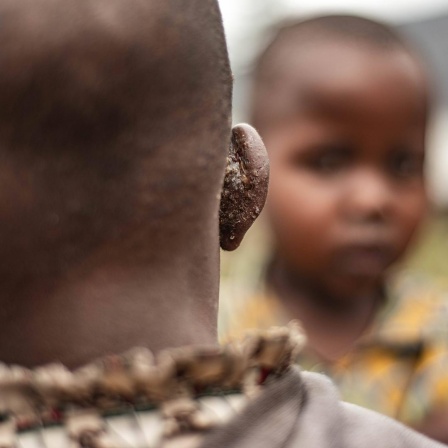 Großaufnahme eines Kinderkopfes von hinten. Das Kind hat am Ohr die für eine Mpox-Infektion typischen Pocken.