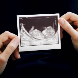 Zwei Frauenhände halten das Ultraschallbild eines ungeborenen Kindes.