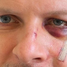 Nahaufnahme des Gesichts von SPD-Politiker Matthias Ecke, nachdem er tätlich angegriffen und schwer verletzt wurde.
