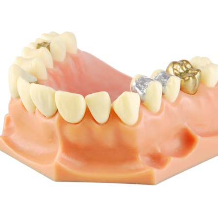 Zahnmodell mit verschiedenen Behandlungen
