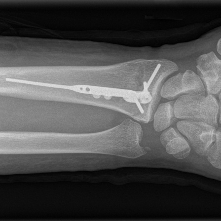 Ein Röntgenbild zeigt die Fraktur einer Speiche am Handgelenk die mit einem Metallimplantat verstärkt wurde.
