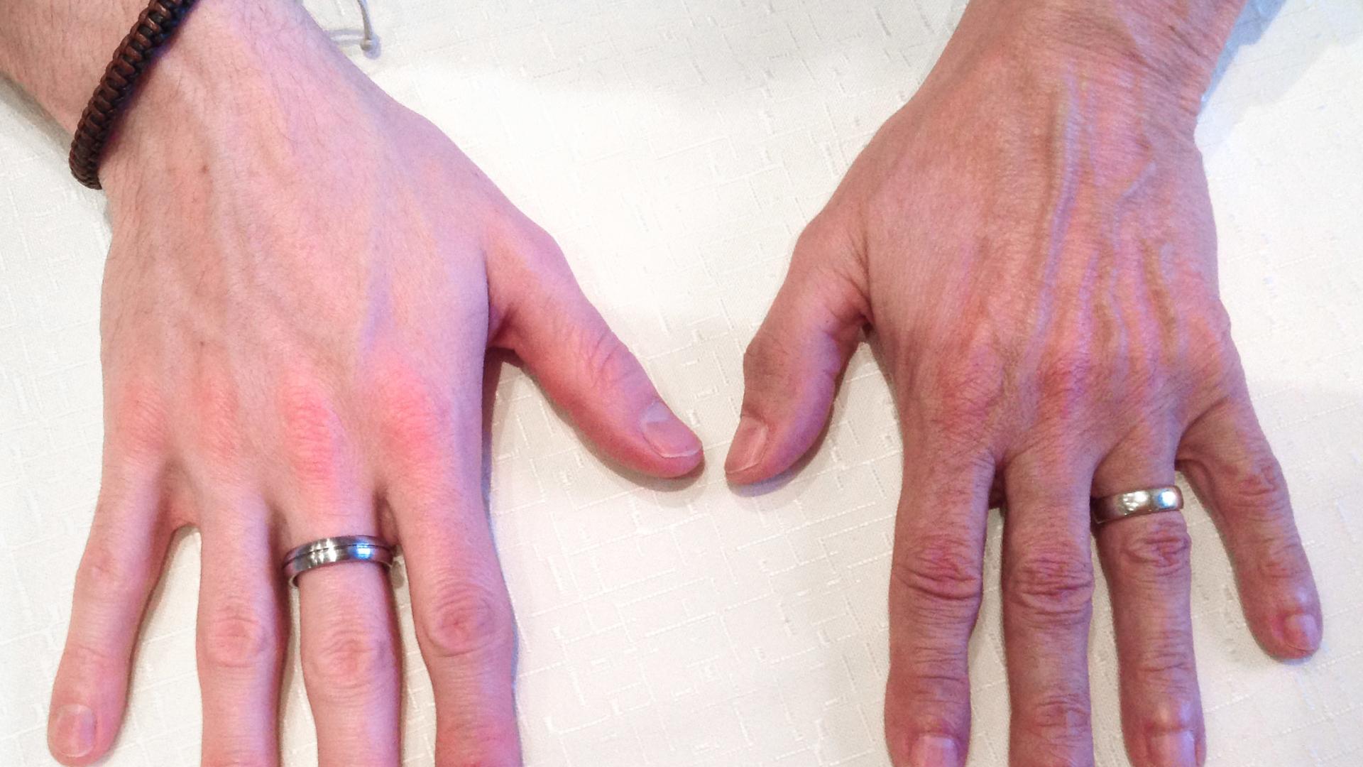 Raynaud-Syndrom Erkennen Und Behandeln – LHAHG