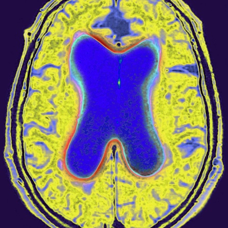 Radiales MRT des Gehirns. (Erweiterung aufgrund altersbedingter Hirnatrophie, Alzheimer-Krankheit).