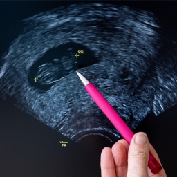 Eine Frauenärztin deutet auf den Fötus im Ultraschallbild. 