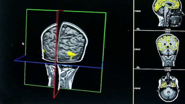 Computergrafik: Gehirn im MRT
