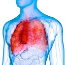 Von Krankheit befallene Lunge