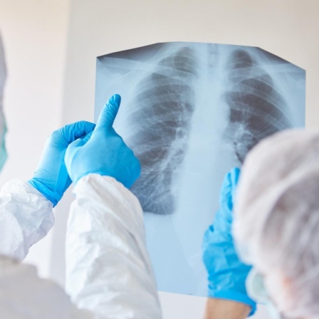 Ärzte in Schutzkleidung schauen sich ein Röntgenbild einer Lungenentzündung eines COVID-19 Patient an 