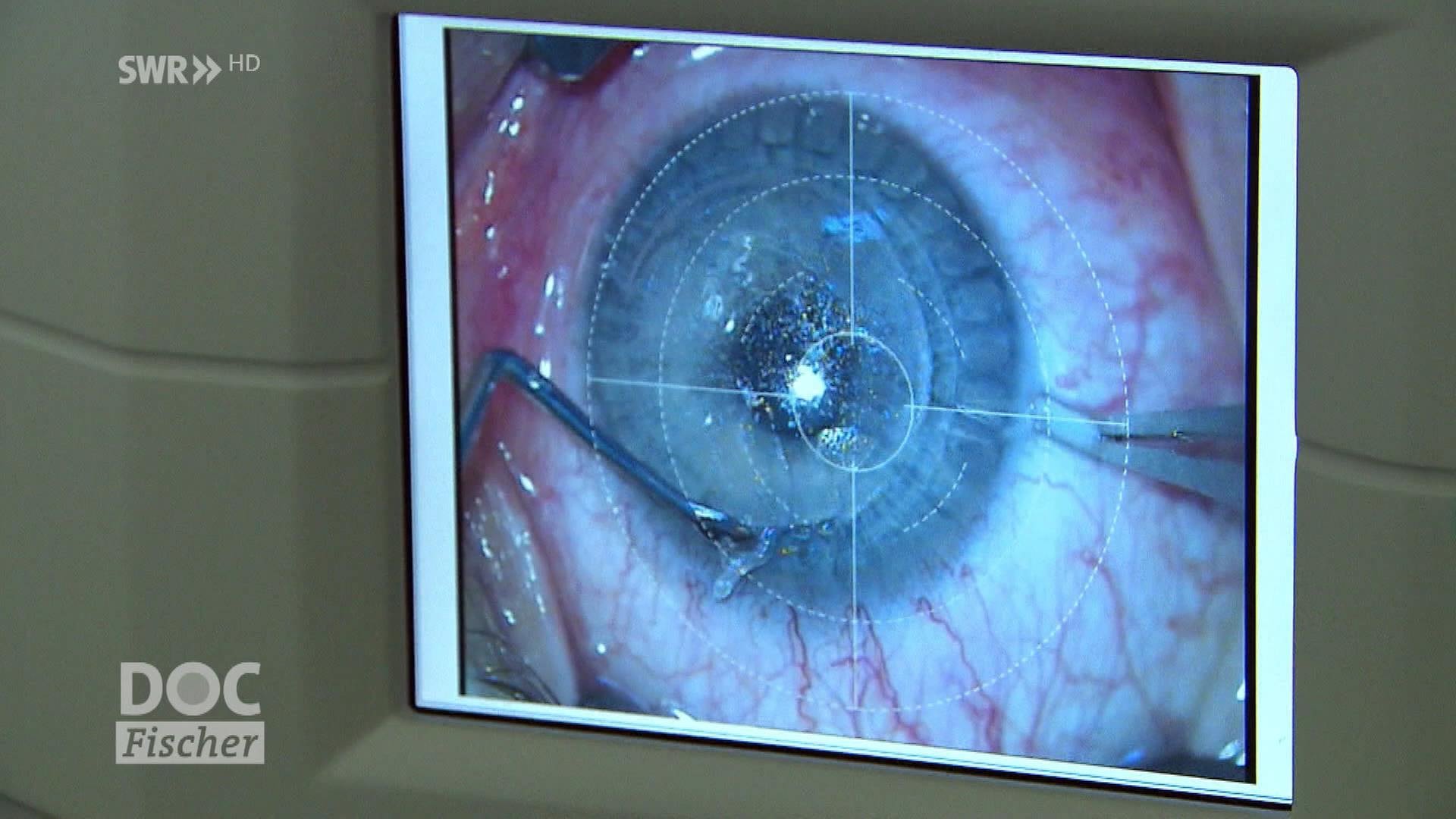 Doc Fischer Augen lasern die richtige Methode ist entscheidend ARD