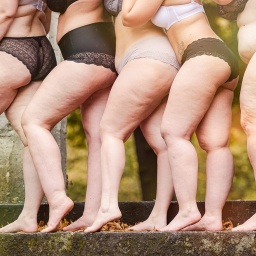 Frauen mit Lipödem, einer Störung der Fettgewebsverteilung.
