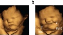 Ultraschallbilder belegen, dass Babys im Mutterleib lächeln, wenn sie etwas Leckeres schmecken